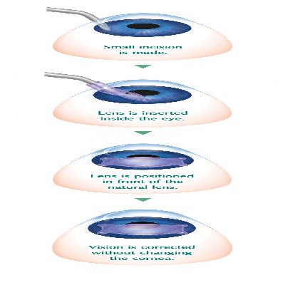 Lens-Based Options